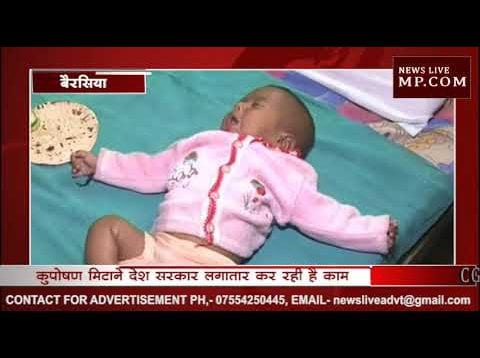 भोपाल के बैरसिया में मिला अति कुपोषित बच्चे