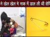 ढाई साल की बच्ची की सर्जरी कर नाक से निकाली सेप्टिपिन