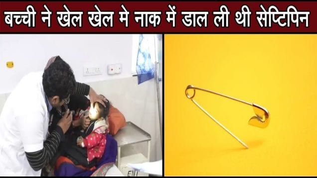 ढाई साल की बच्ची की सर्जरी कर नाक से निकाली सेप्टिपिन