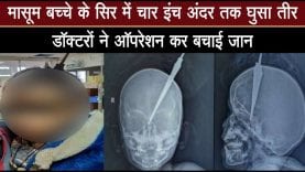 डॉक्टरों ने ऑपरेशन कर निकाला तीर